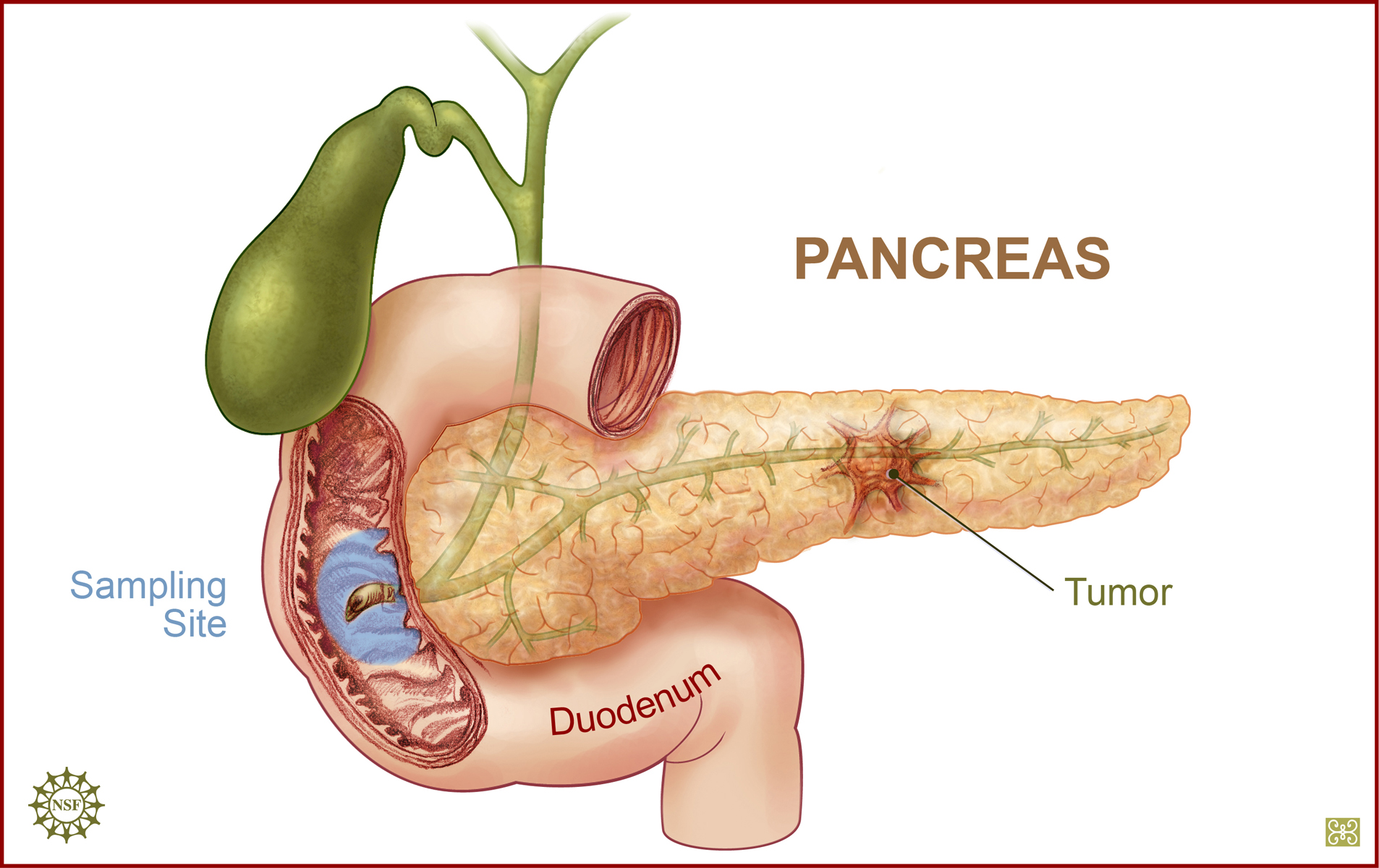 Pankreas Tmr