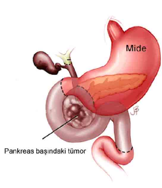 Pankreas Başı Kanseri